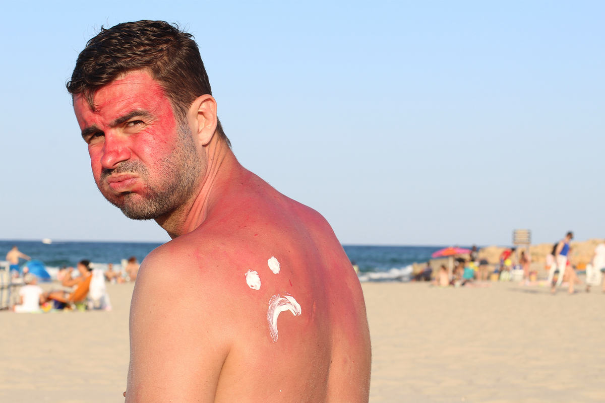 how-long-does-sunburn-last-funboy